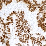 Detection of human p53 in FFPE colon carcinoma by immunohistochemsitry.