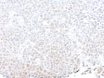 Detection of SMARCB1/SNF5 by immunohistochemistry.