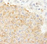 Detection of human expndtw-6 NF2 by immunohistochemistry.