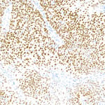 Detection of human p40 in lung carcinoma by IHC.