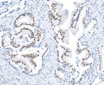 Detection of human BMI1 in FFPE prostate carcinoma by immunohistochemistry.