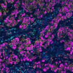 Detection of human CD3E (cyan), CD8 alpha (red), cytokeratin (yellow), granzyme B (green), Ki-67 (orange) and SOX10 (magenta) in FFPE breast carcinoma