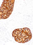 Detection of human HER2/ErbB2/Neu by immunohistochemistry.