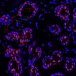 Detection of human PBRM1 in FFPE breast by immunohistochemistry-IF.
