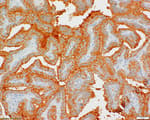 Detection of human BRAF by immunohistochemistry.