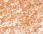 Detection of human ALK by immunohistochemistry.