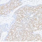 Detection of human MED1 in FFPE lung carcinoma by immunohistochemistry.