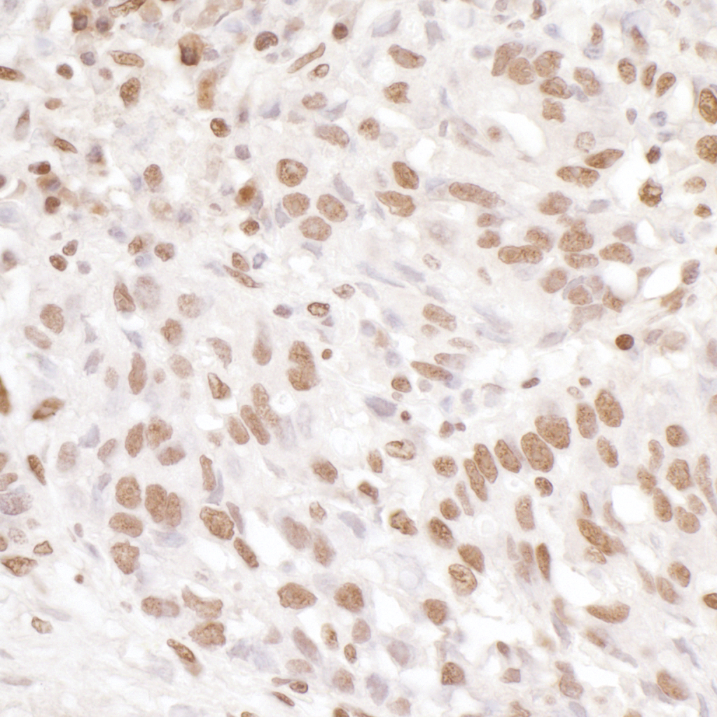 Detection of human EWS by immunohistochemistry.