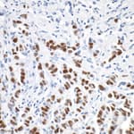 Detection of human Progesterone Receptor in FFPE breast carcinoma by immunohistochemistry.