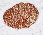 Detection of human HER2/ErbB2/Neu by immunohistochemistry.