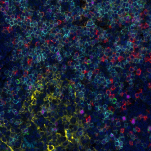 T Cell Status PathPlex Panel (CD3E, Cytokeratin, CD8 alpha, CD4, LAG3, FOXP3)