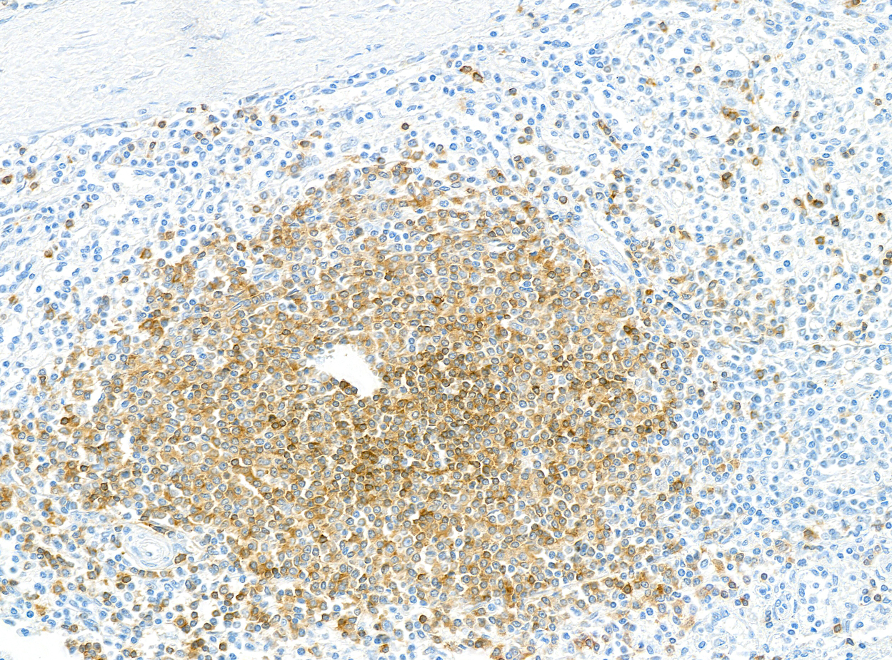 Detection of human CD79B by immunohistochemistry.