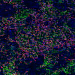 Detection of human CD3E (orange), CD8 alpha (red), and PD-L1 (green) in FFPE breast carcinoma by IHC-IF.
