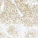 Detection of human p40 in lung carcinoma by IHC.