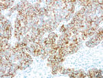 Detection of human CK7 in breast carcinoma by IHC.