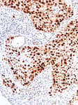 Detection of human p53 by immunohistochemistry.