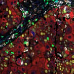 Detection of human CD3E (cyan), CD8 alpha (green), CD68 (orange), CK (red), Ki67 (yellow) and PD-L1 (white) in FFPE HNSCC by IHC-IF.