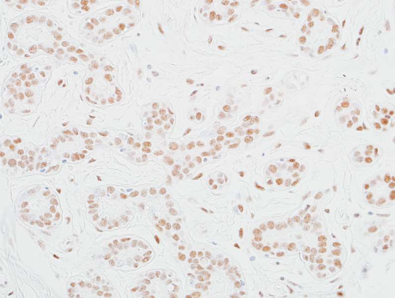 Detection of human MED12 in FFPE breast carcinoma by IHC.