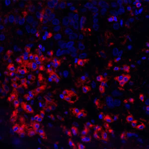 Detection of human VISTA (red) in FFPE ovarian carcinoma by IHC-IF.