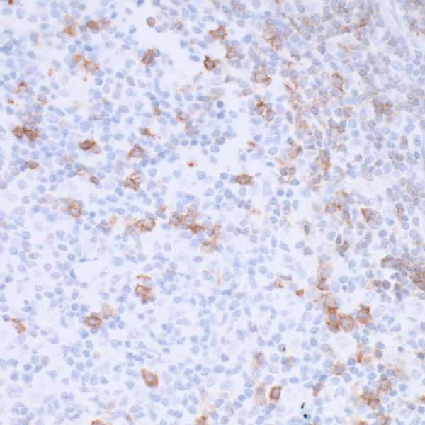 Detection of human PD-1 in FFPE Hodgkin's lymphoma by IHC.