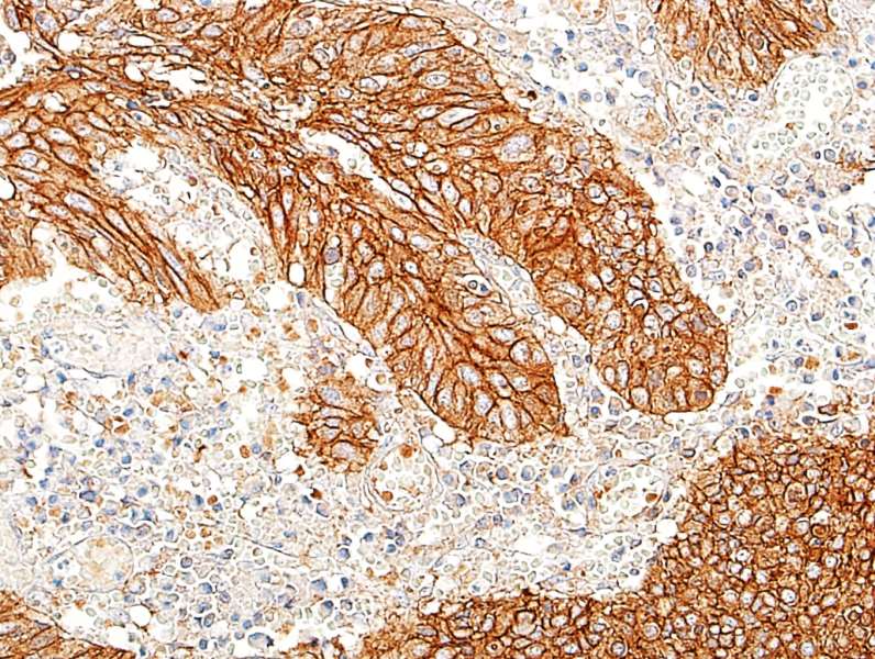 Detection of human E-Cadherin in FFPE lung carcinoma by IHC.