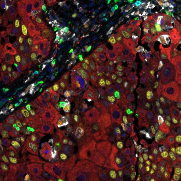 Detection of human CD3 (teal), CD8 (green), CD68 (orange), CK (red), Ki67 (yellow) and PD-L1 (white) in FFPE HNSCC by IHC-IF.
