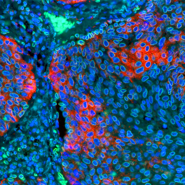 Detection of human PD-L1 (red) and Lamin-A/C (green) in FFPE lung by IHC-IF.