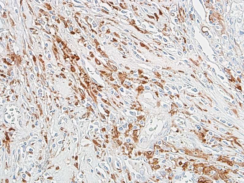 Detection of human ALDH1A1 in FFPE breast carcinoma by IHC.