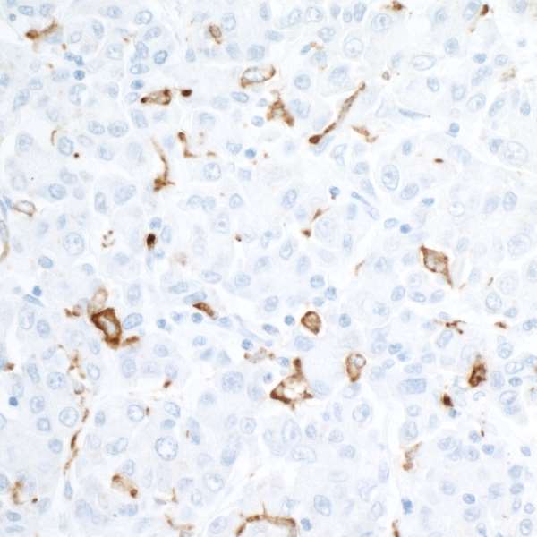 Detection of human CD163 in FFPE liver carcinoma by IHC.