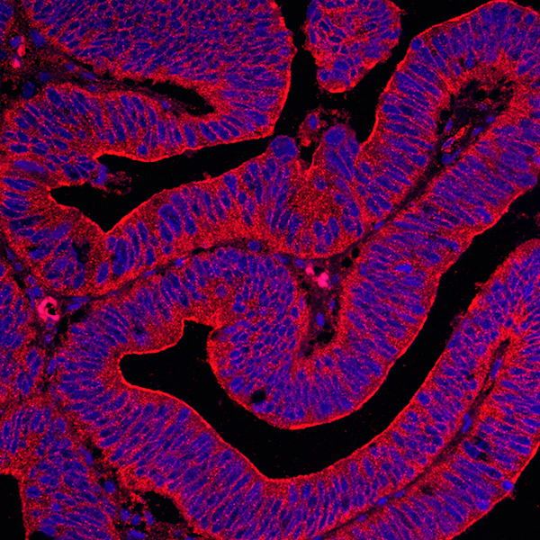 Detection of human Fliamin B (red) in FFPE prostate carcinoma by IHC-IF.