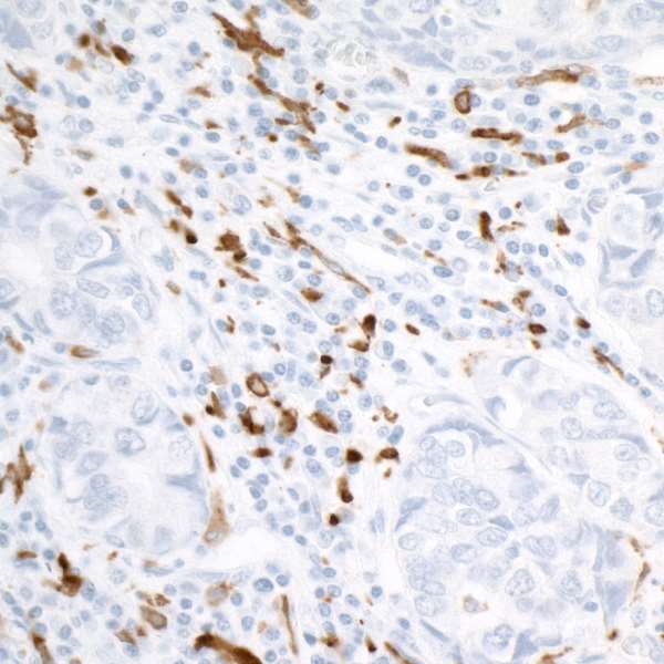 Detection of human CD163 in FFPE lung carcinoma by IHC.