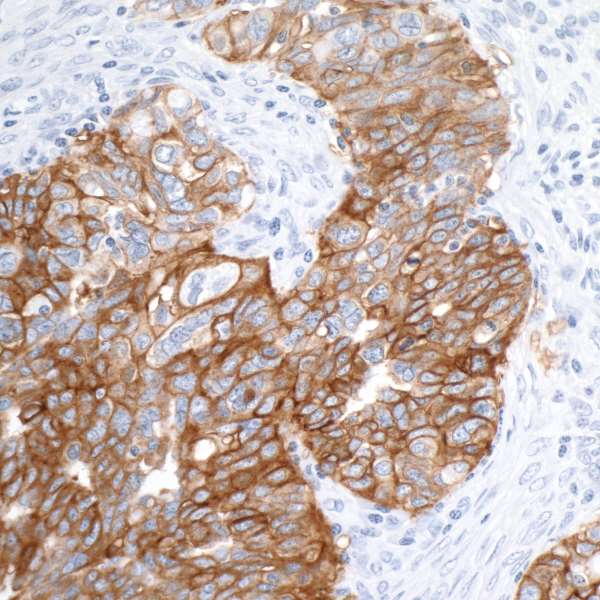 Detection of human EpCAM in FFPE ovarian carcinoma by IHC.