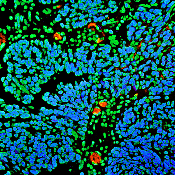 Detection of human BRD4 in FFPE ovarian carcinoma by IHC-IF (pseudo color). 