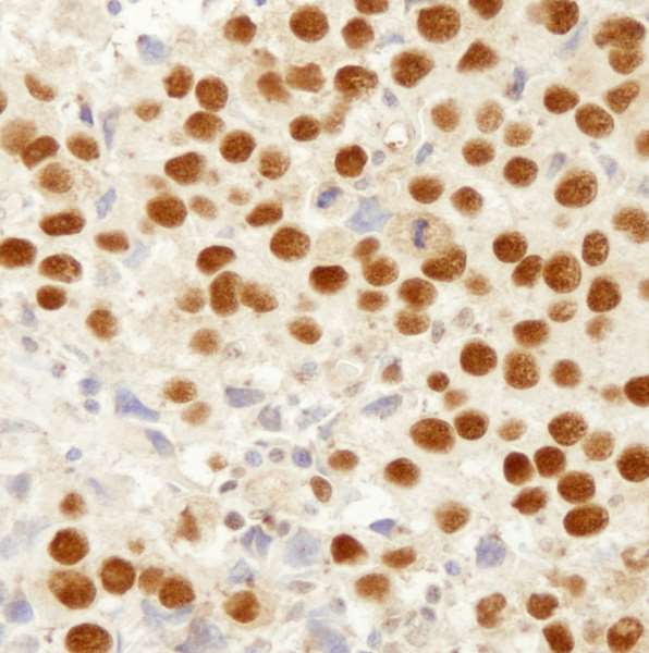 Detection of human MSH2 by immunohistochemistry.