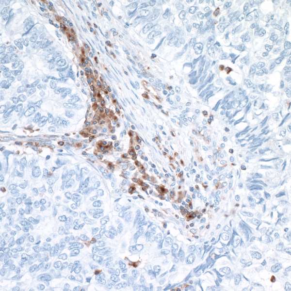 Detection of human VISTA in FFPE lung carcinoma by IHC.