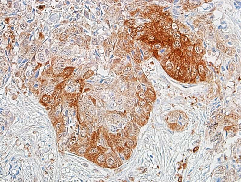Detection of human ALDH1A1 in FFPE lung carcinoma by IHC.
