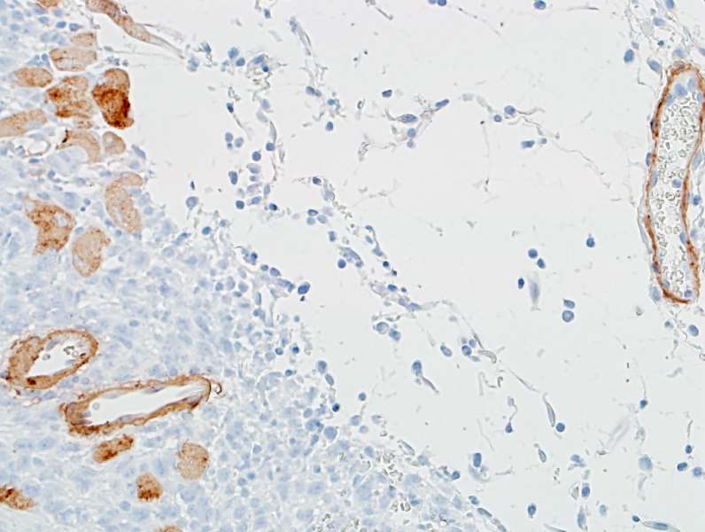 Detection of mouse alpha Smooth Muscle Actin in FFPE colon carcinoma CT26 by IHC.