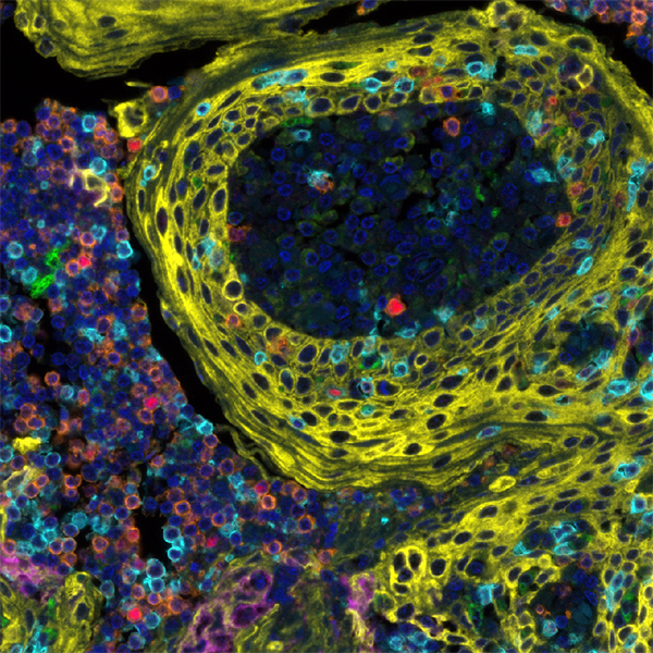 Multiplex immunofluorescence image stained using the Activated T Cell PathPlex Panel.