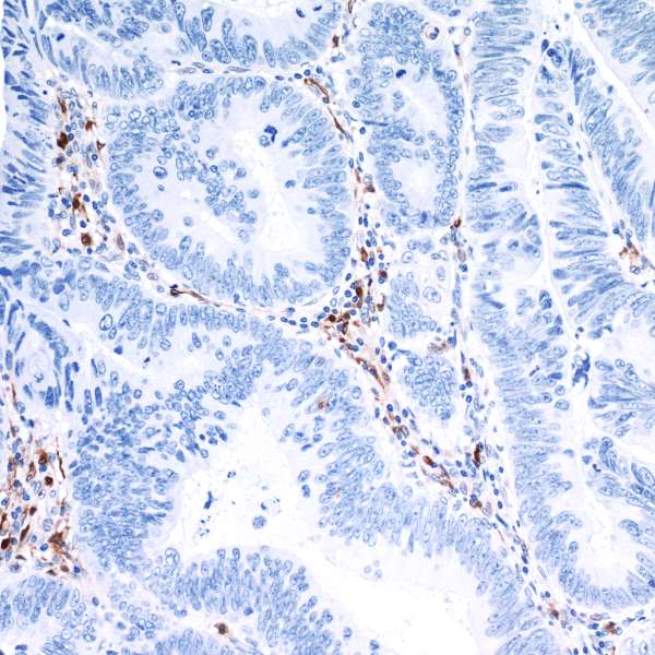 Detection of human IDO1 in FFPE colon carcinoma by IHC.