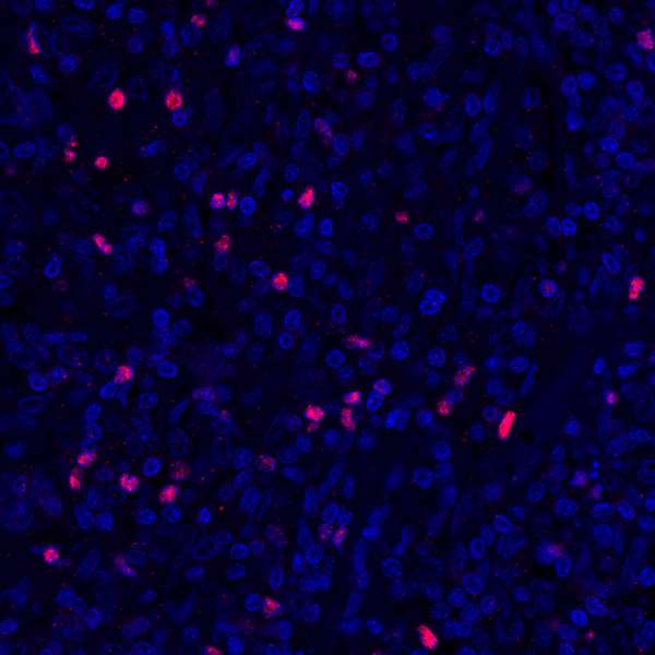Detection of human FOXP3 (red) in FFPE breast carcinoma by IHC-IF.