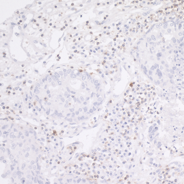 Detection of human CD247/CD3Z in FFPE lung carcinoma IHC.