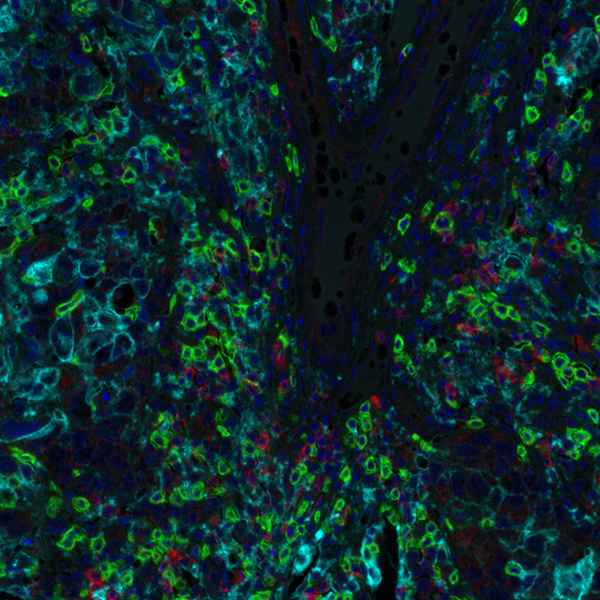 Detection of human CD8 (green) TIGIT (red) and PD-L1 (cyan) in breast carcinoma by IHC-IF.