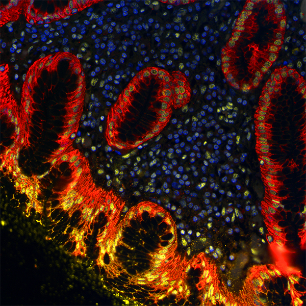Detection of human BRD4 (yellow) and Cytokeratin (red) in FFPE gastric carcinoma by IHC-IF.