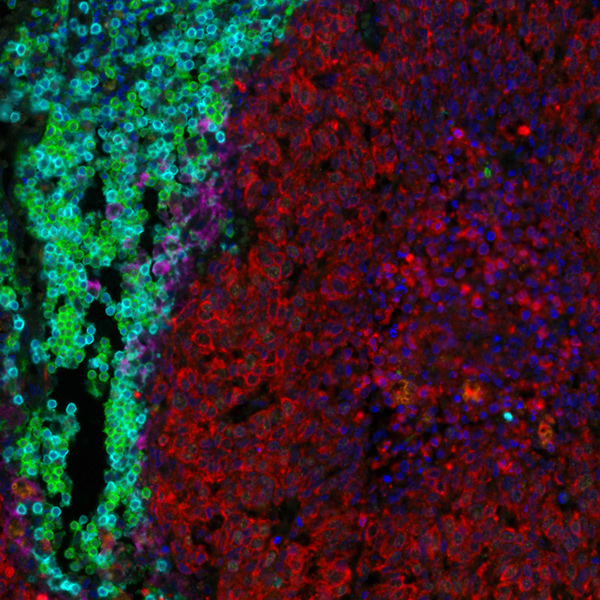 Detection of human CD3 (aqua), CD8 (green), cytokeratin (red), and PD-L1 (magenta) in FFPE lung carcinoma by IHC-IF.