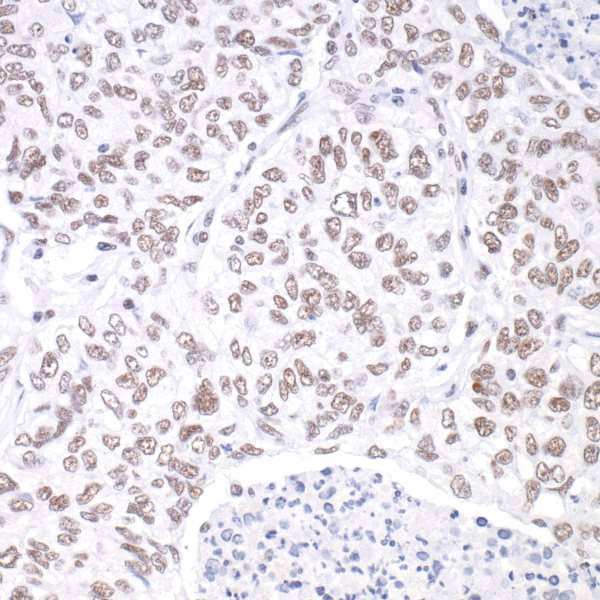 Detection of human hSET1 in FFPE lung carcinoma by IHC.