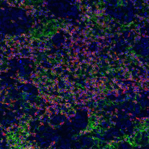 Detection of human CD3E (orange), CD8 alpha (red), and PD-L1 (green) in FFPE breast carcinoma by IHC-IF. 