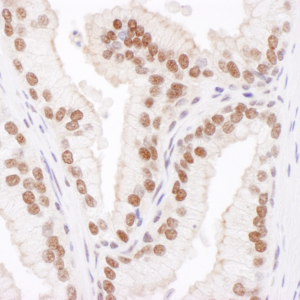 Detection of human Cul4B in FFPE prostate carcinoma by IHC.