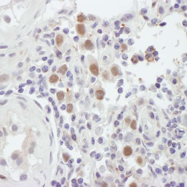 Detection of human MSH6 by immunohistochemistry.