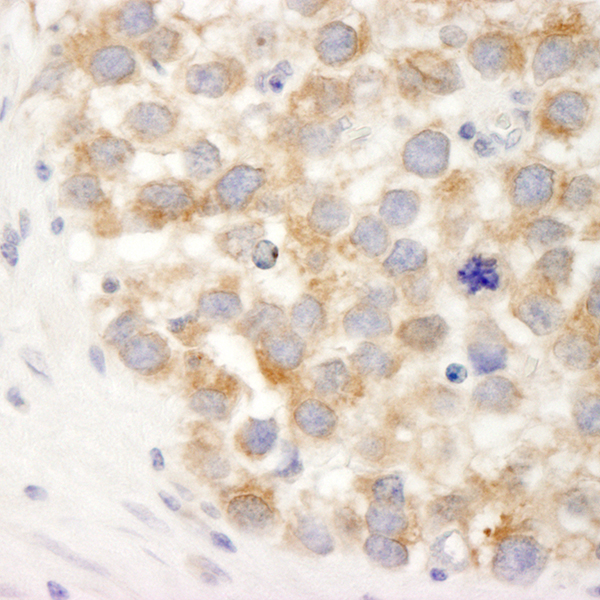 Detection of human DDX3 in FFPE seminoma by IHC.
