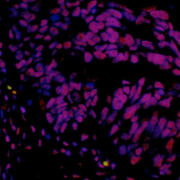 Detection of human hSET1 (red) in FFPE ovarian carcinoma by IHC-IF.